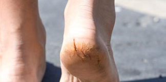 6 razloga zbog čega vam koža na petama puca i guli se guljenje koze