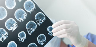 Nakon moždanog udara dvaput veći rizik od raka mozdani rak