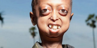 Ubrzano starenje djecak2